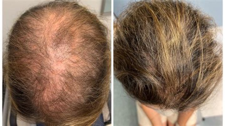 Does Matt Lucas have hair loss?