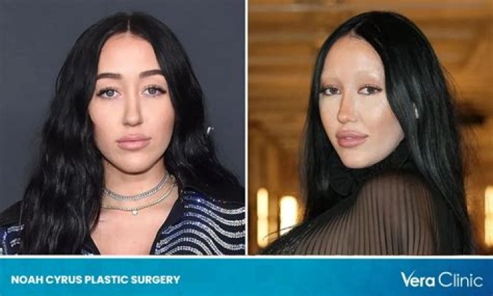 Noah Cyrus’s Plastic Surgery Speculations and Experts’ Opinions on Her Appearance
