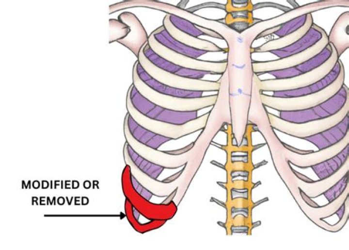 Transformative Journeys: Rib Removal Before After