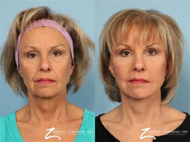 Ultimate Guide To Tiffani Faison's Face Surgery Transformation