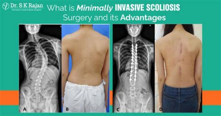 Understanding Scar Scoliosis Surgery: Healing Beyond The Curve