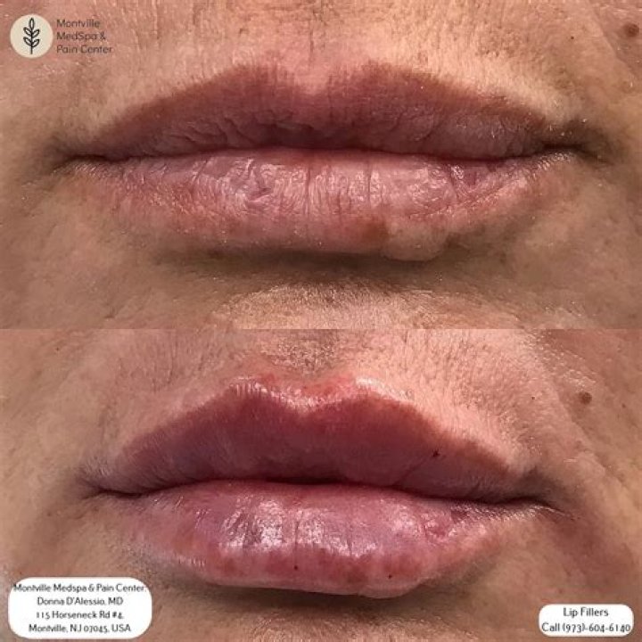 When Beauty Goes Wrong: Understanding Botched Fillers